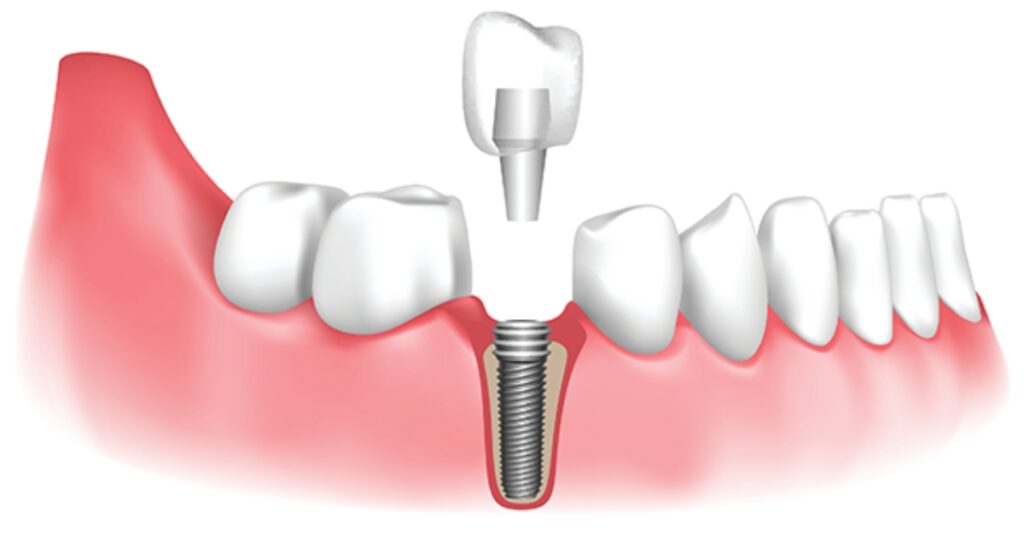 Dental Implants